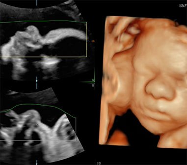 超音波専門医・胎児心臓病認証医による<br>超音波スクリーニング（3D/4D）